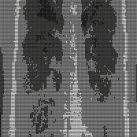 BlanketCXR.jpeg